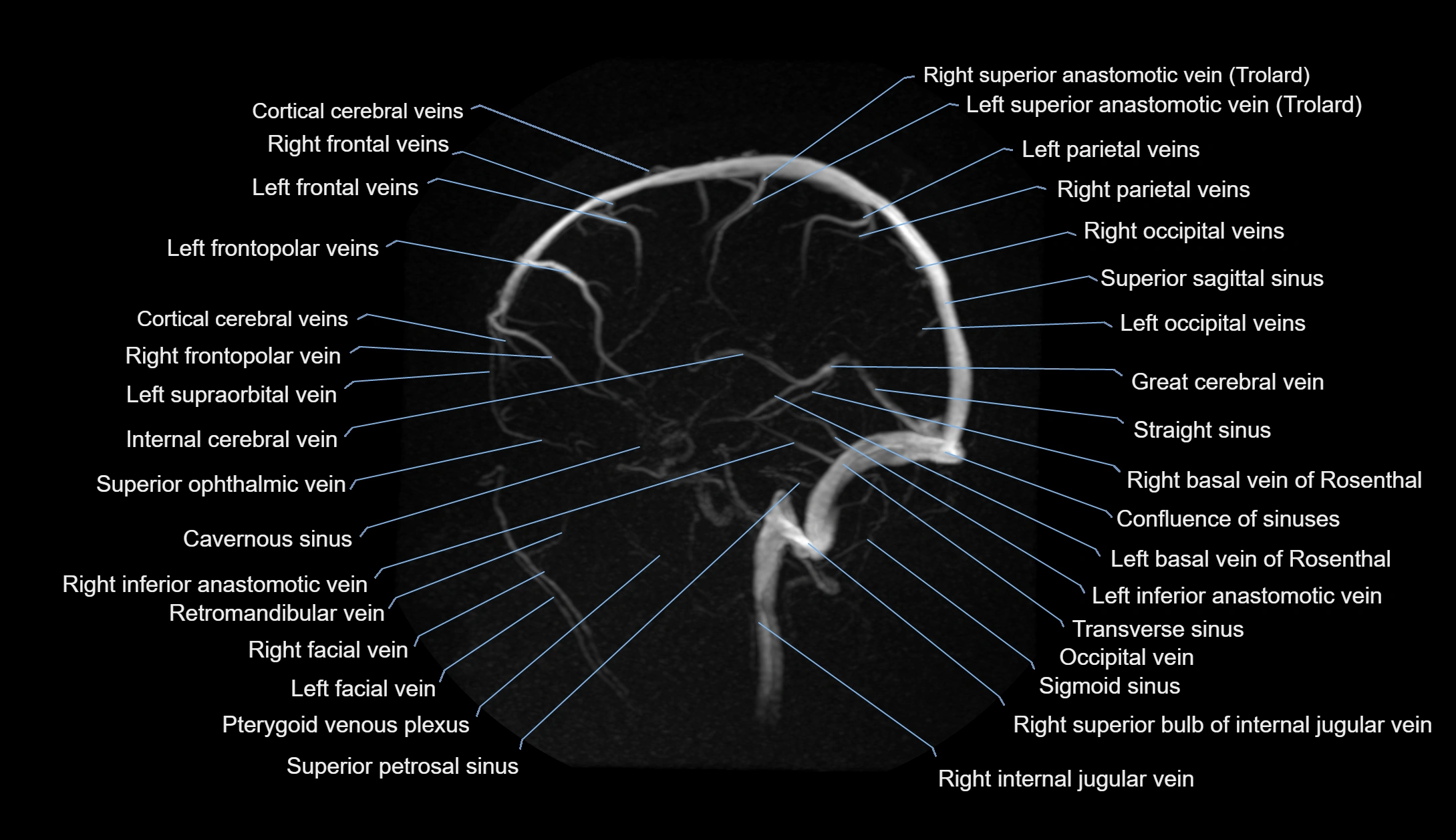 MRV brain MIP sagittal labelled anatomy 3T MRI images -img-1011001-00006.webp